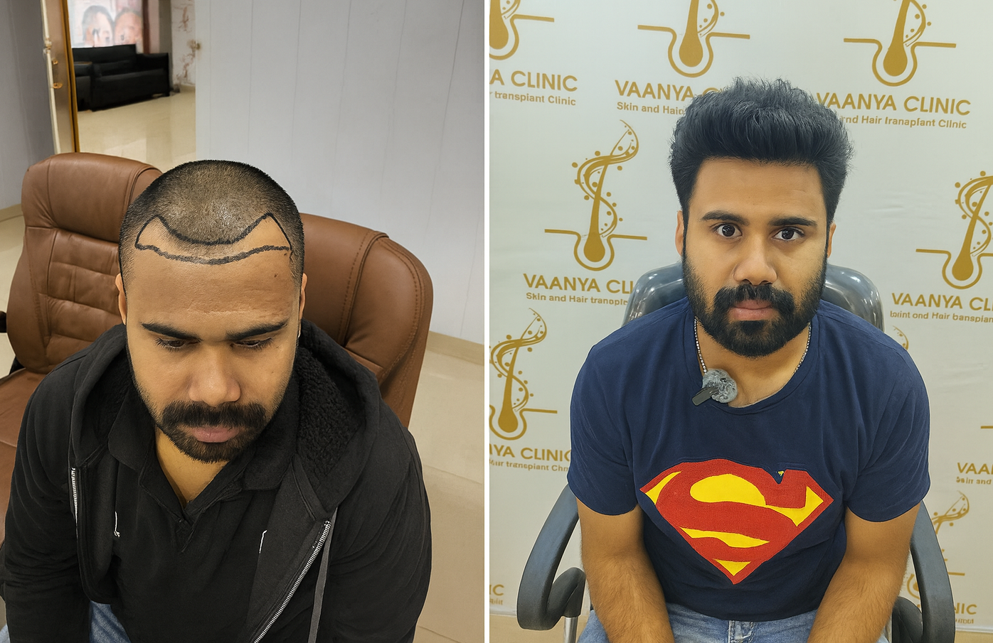 Hair Transplant Before and After