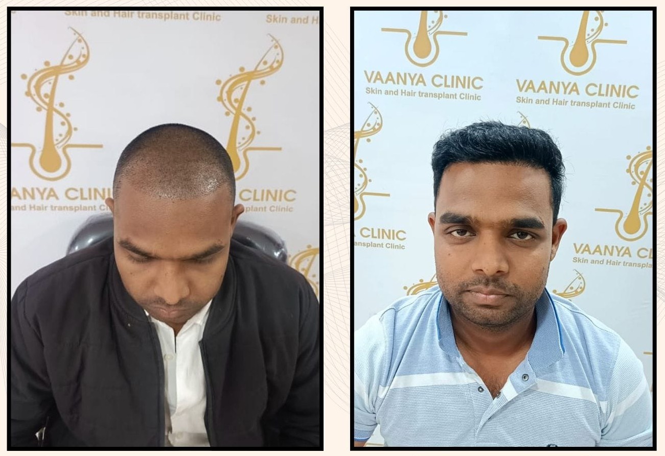 Before and After Hair Transplant