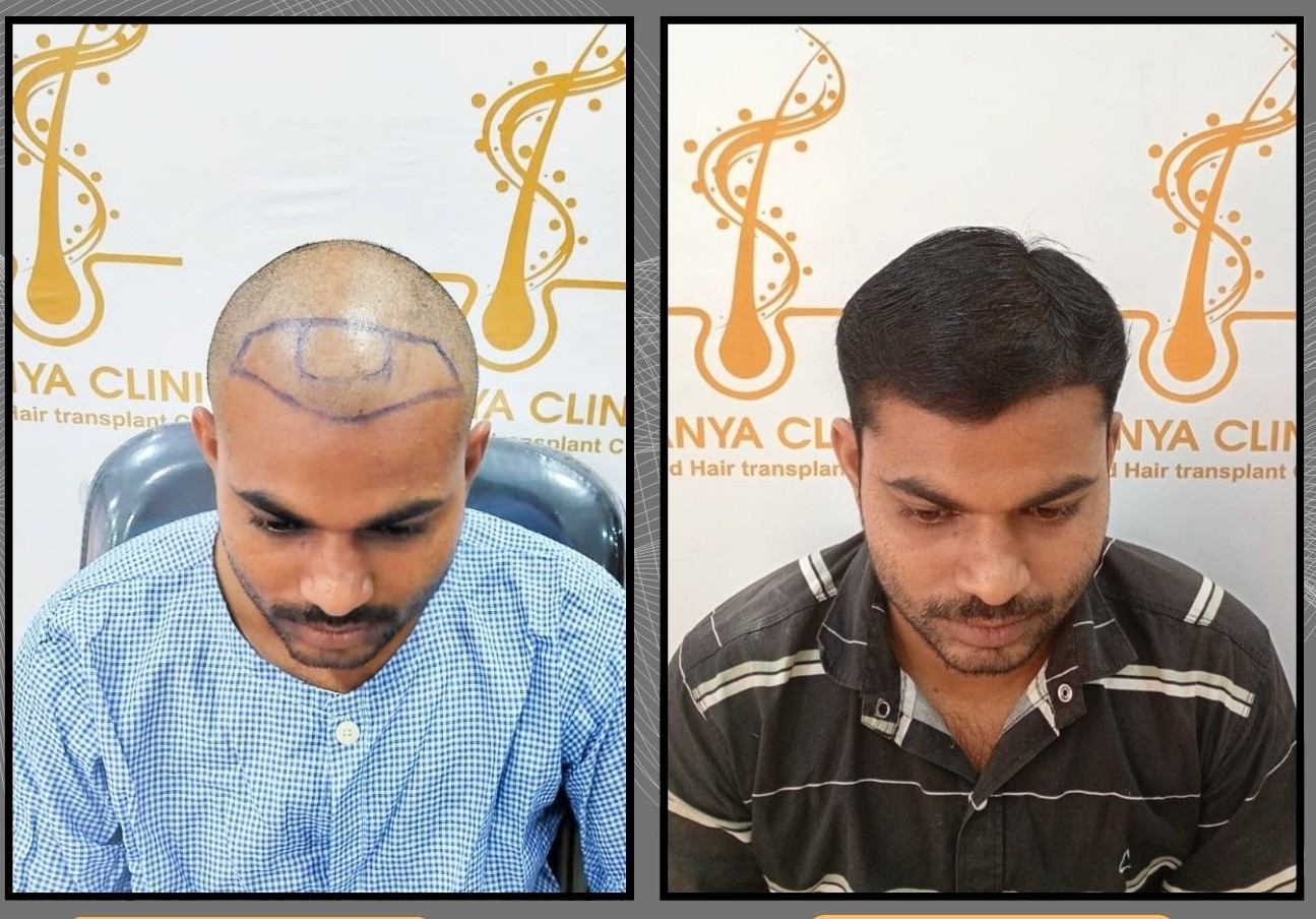 Hair Transplant Clinic Video